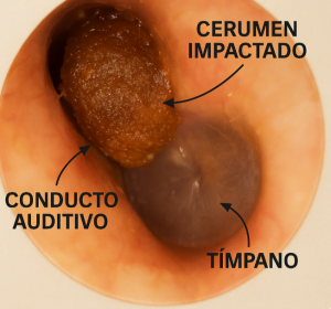 Cerumen impactado