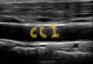 CAROTIDA ECOGRAFIA