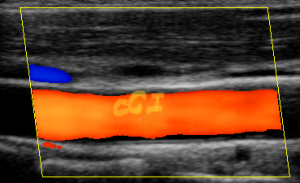 CAROTIDA ECO DOPPLER COLOR