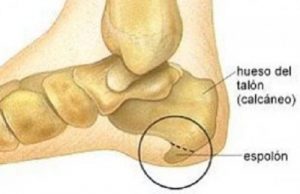 Fascitis plantar – Espolón calcaneo