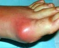 Gota – Pseudogota