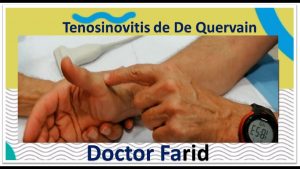 Tenosinovitis de De Quervain, Relato de Armando