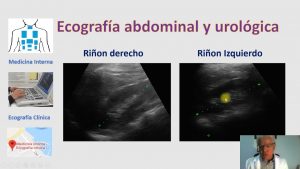 Cólico renal, semejanzas con lumbago, fibromialgia, colon irritable