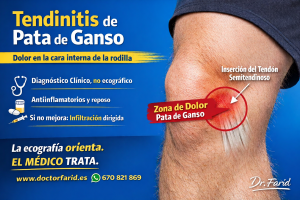 Tendinitis de pata de ganso: el médico cura, la ecografía orienta